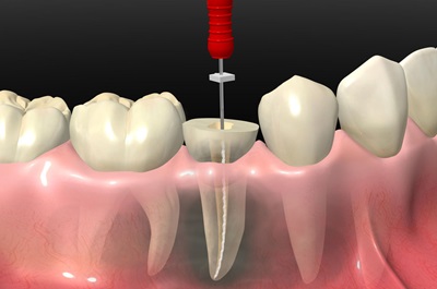 Endodonzia